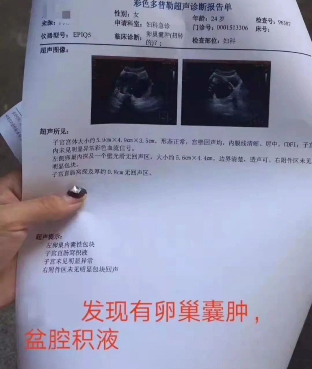 可以进一步观察身体是否有不适症状,如果囊肿在5公分之上那么就需要