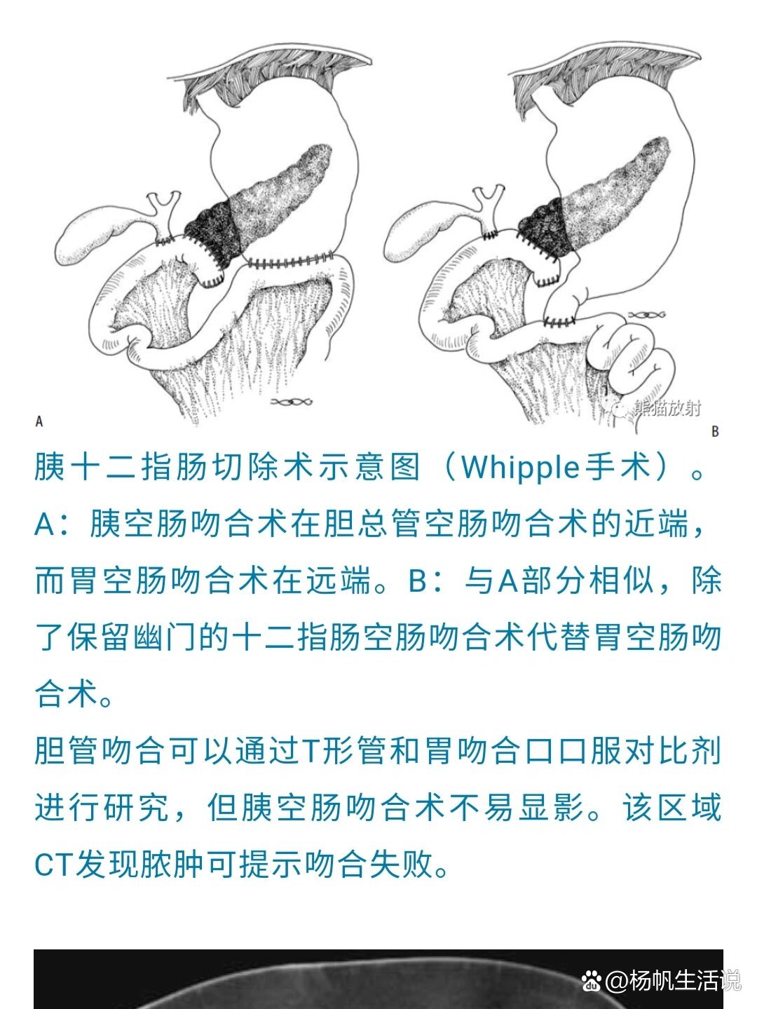 学习胃肠吻合术