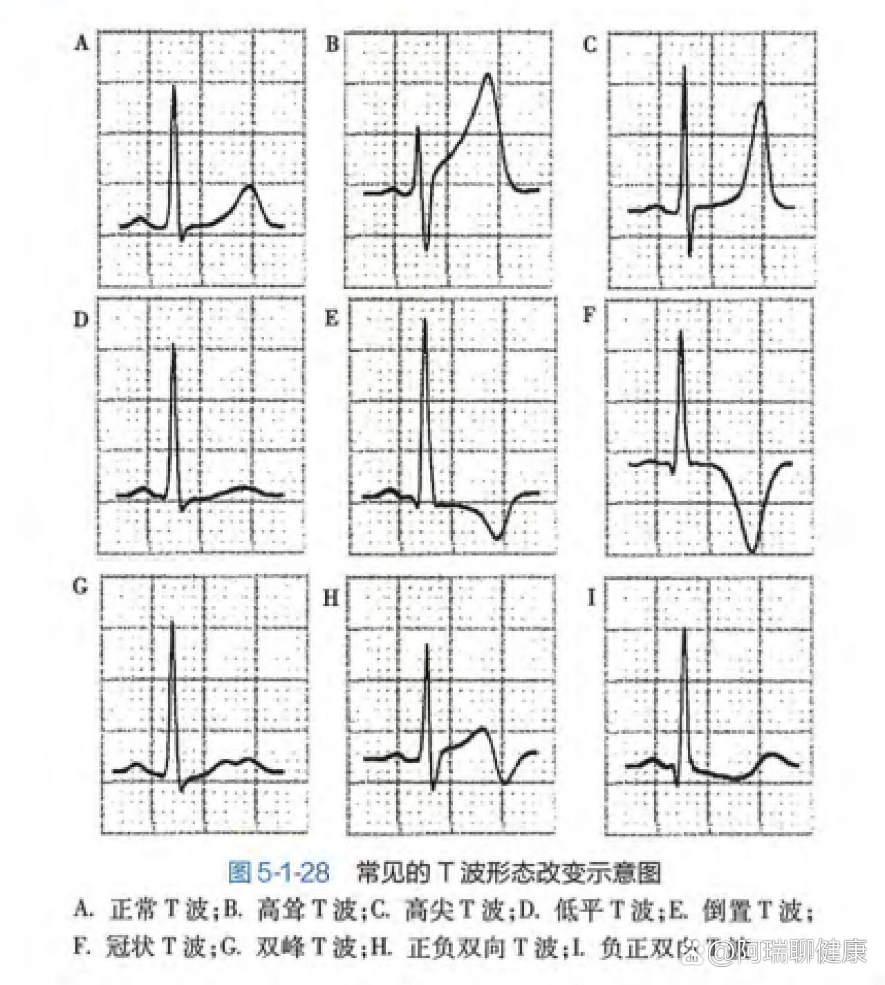 心电图T波双向图片