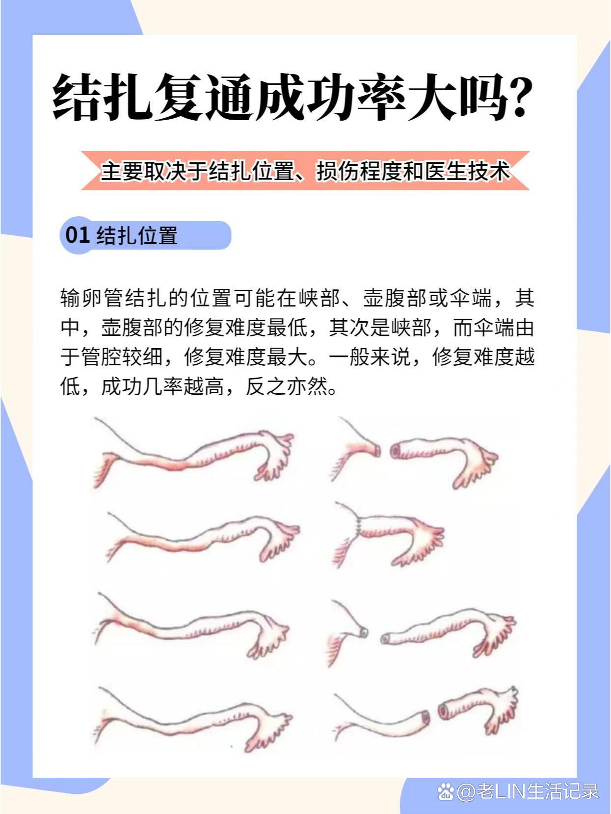 女性结扎开腹 录像图片