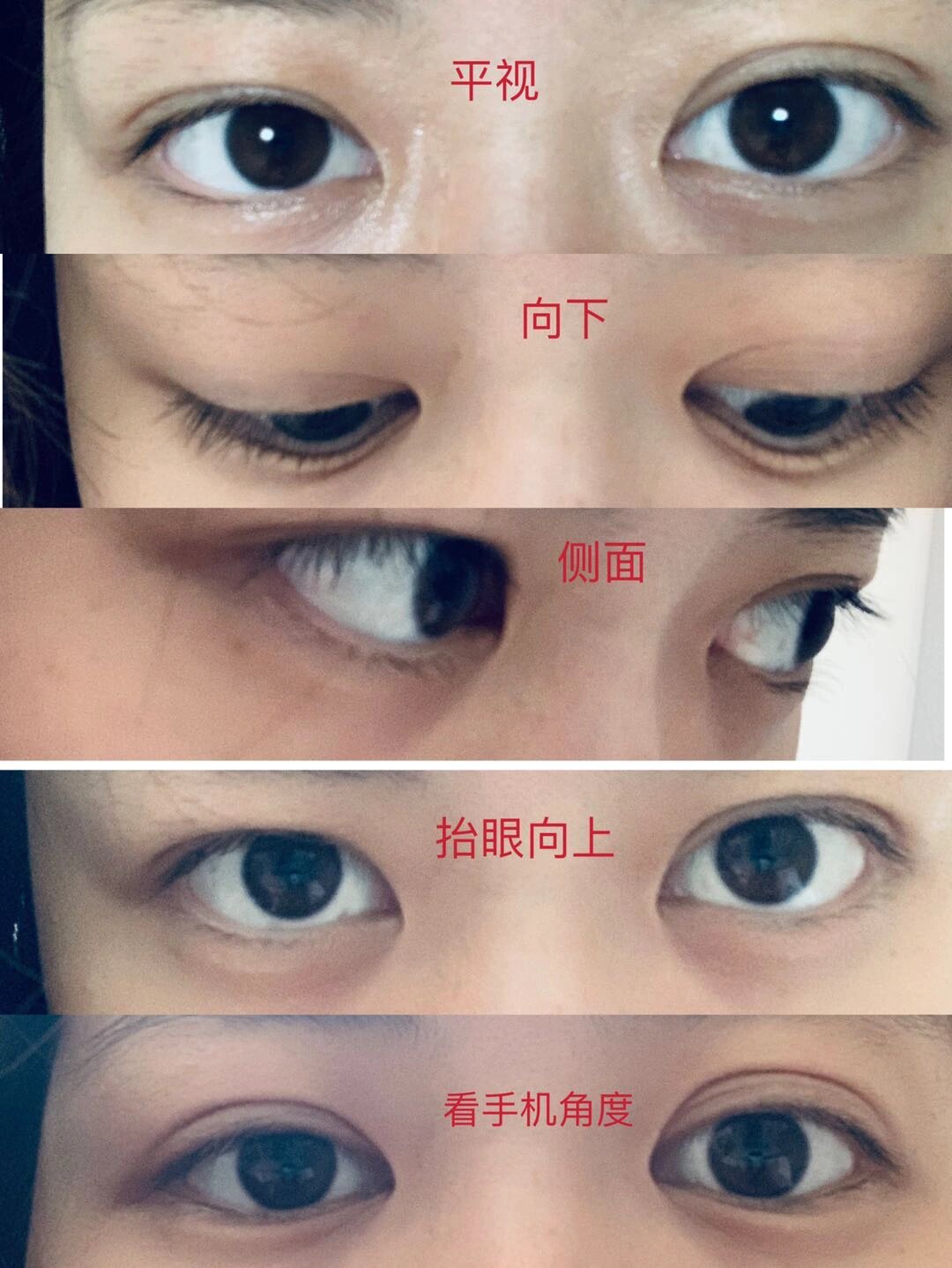 甲亢突眼