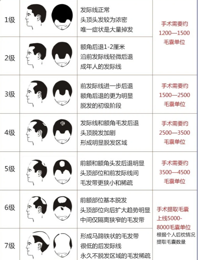 植发法师(我想植发,谁能给普及一下植发的知识?)