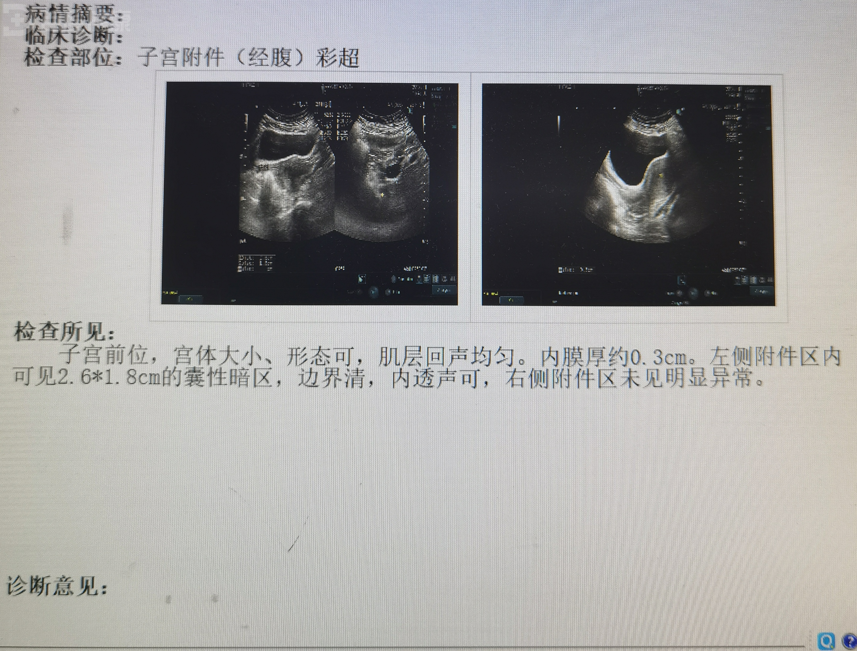 一例关于卵巢滤泡囊肿的病例分享