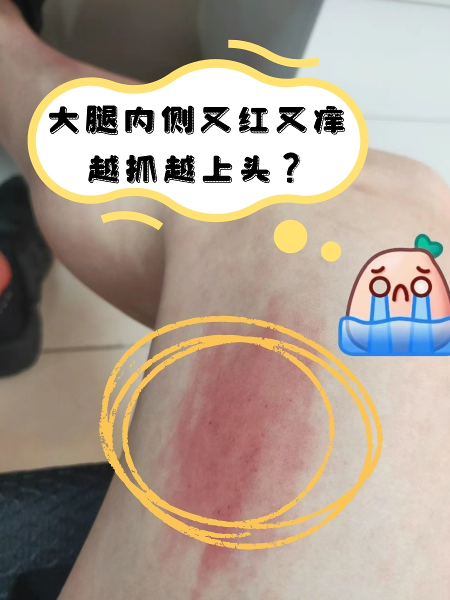 大腿里子起疙瘩特别痒图片