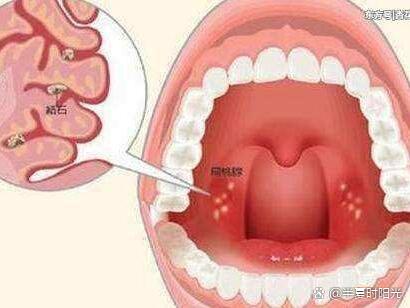 嗓子两边扁桃体像蜂窝图片