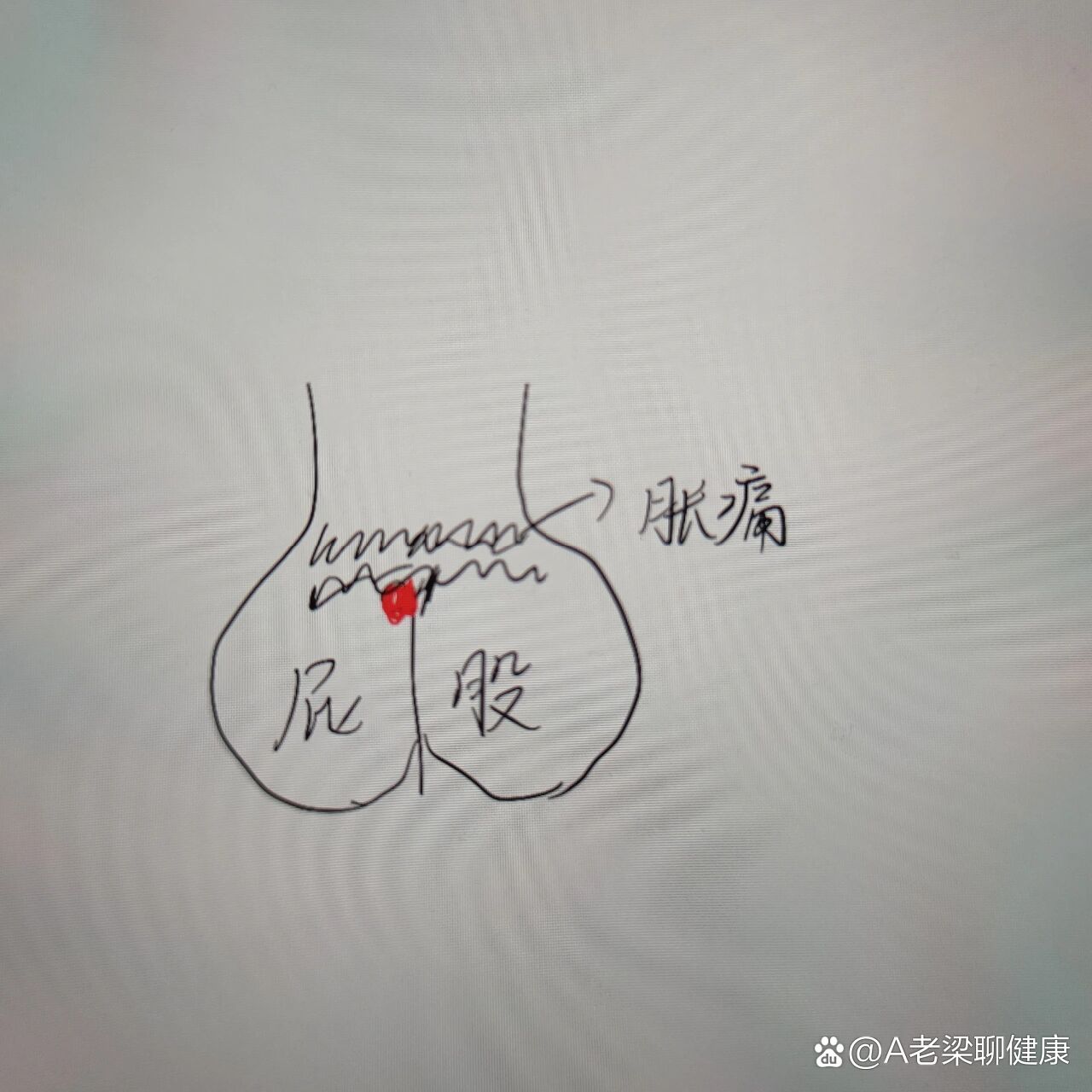 尾骨增生图片