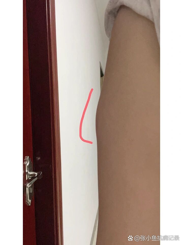 打完乙肝疫苗手臂肿了一块98