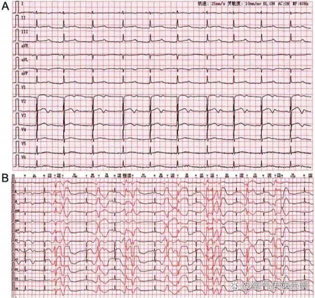 bpm者,qt间期正常值为360～440 ms,>440 ms为qt间期延长(即长qt间期)