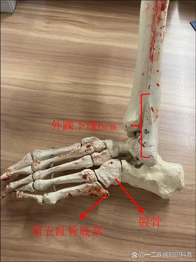 右脚骰骨图片图片