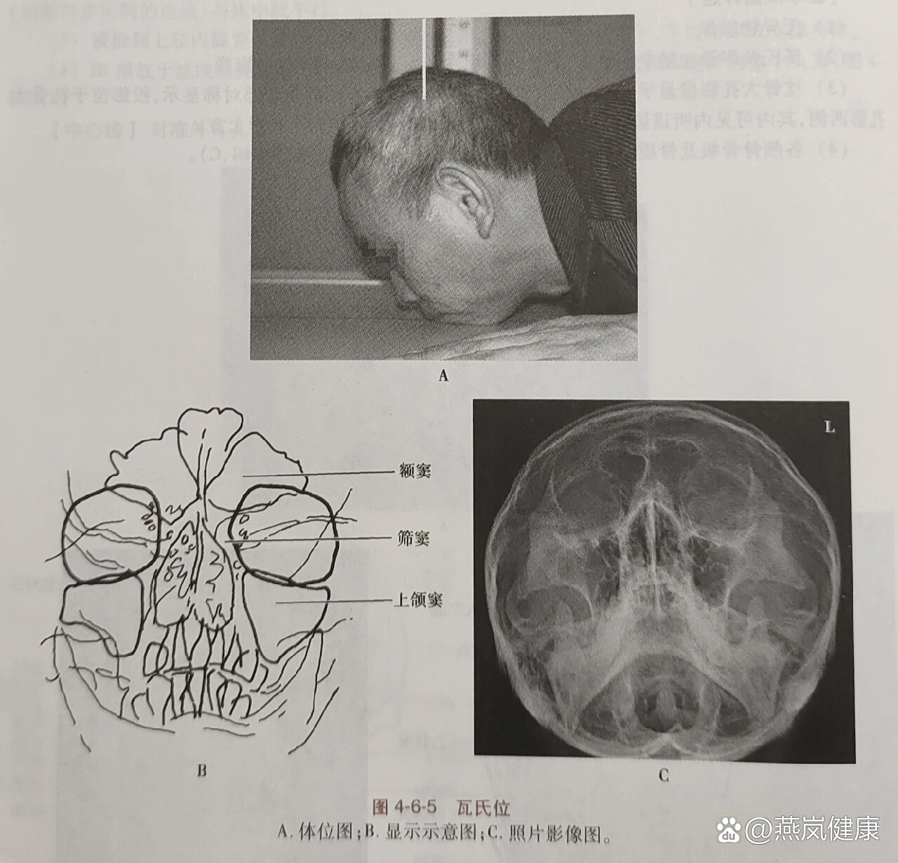 鼻旁窦柯氏位图片图片