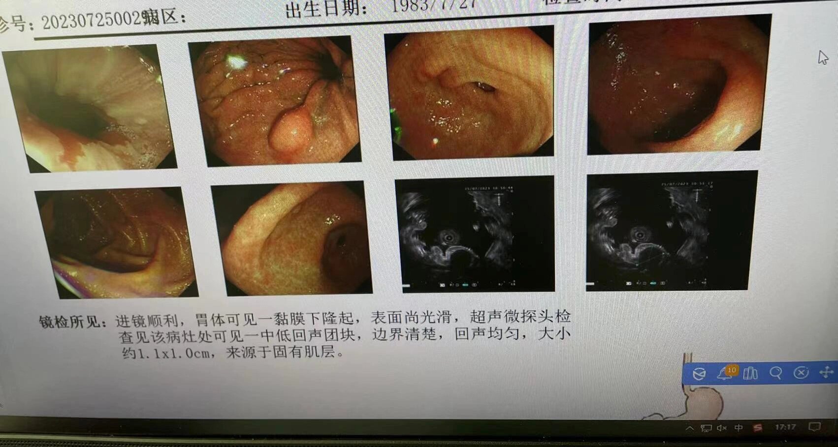 6 报告解读 胃黏膜下隆起