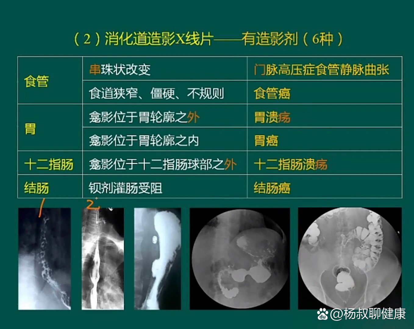 结肠癌x线图片图片