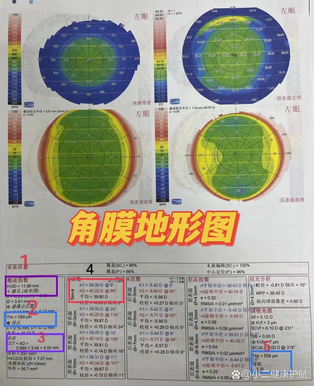 常见角膜地形图图片