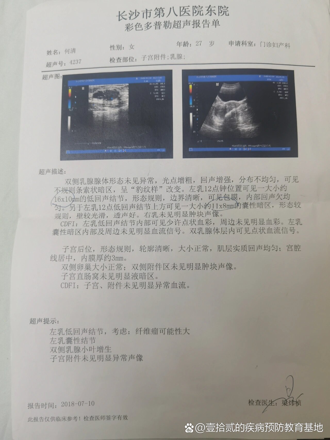 男性乳腺增生病历模板图片