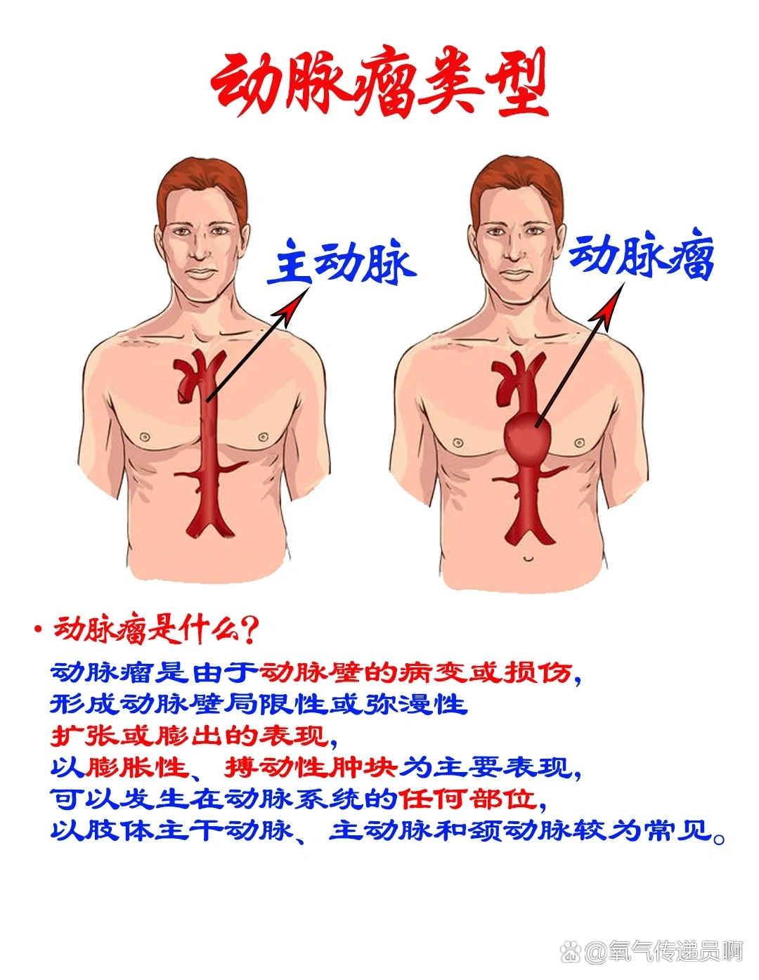动脉瘤类型图文知识科普,腹主动脉瘤.