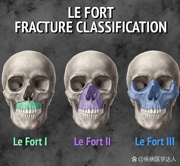  p>lefort br>lefort i 型(guérin 骨折)骨折线穿过硬腭上方的上颌骨