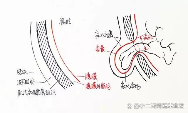 腹股沟斜疝和直疝图解图片