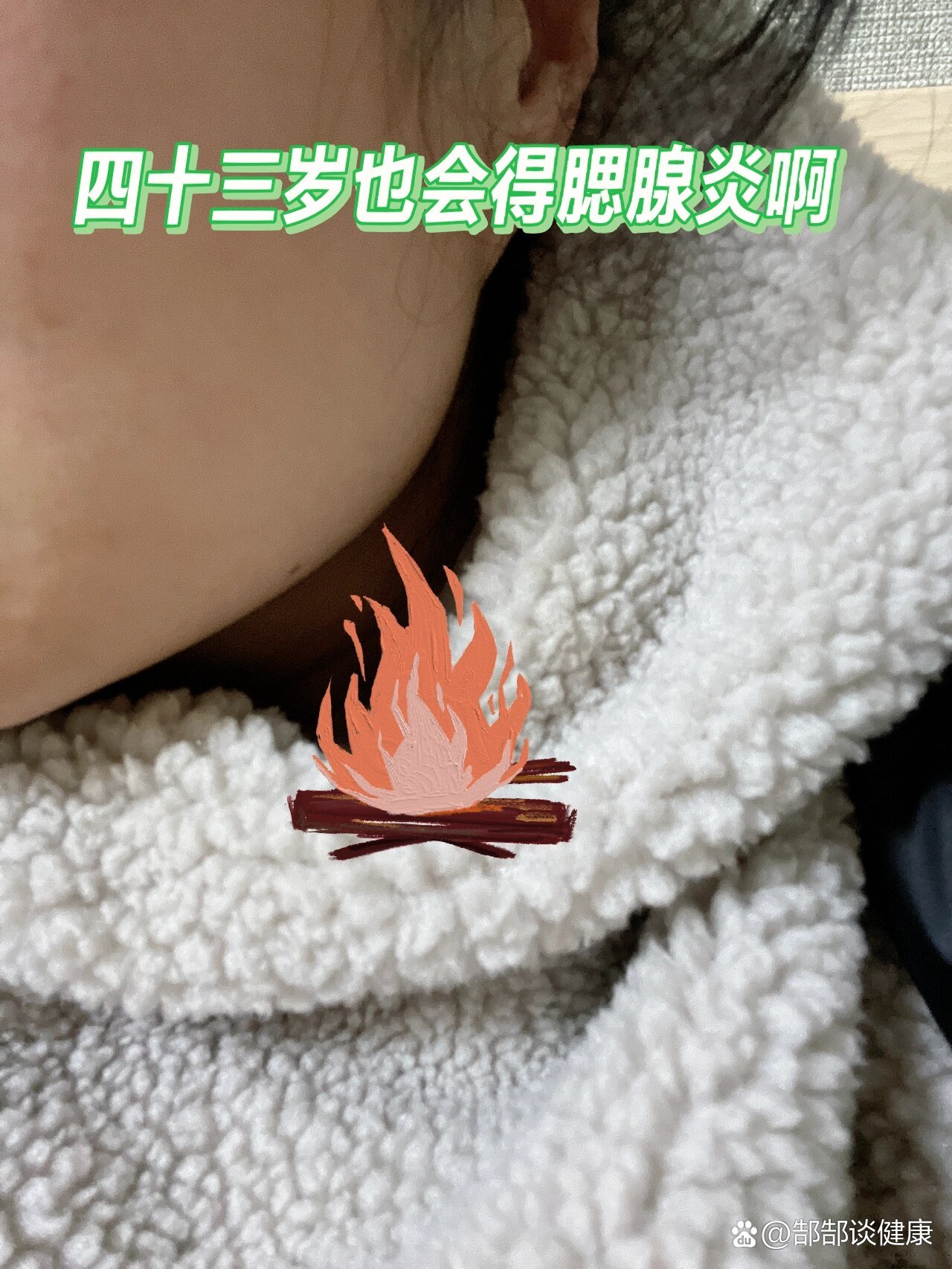 成人腮腺炎