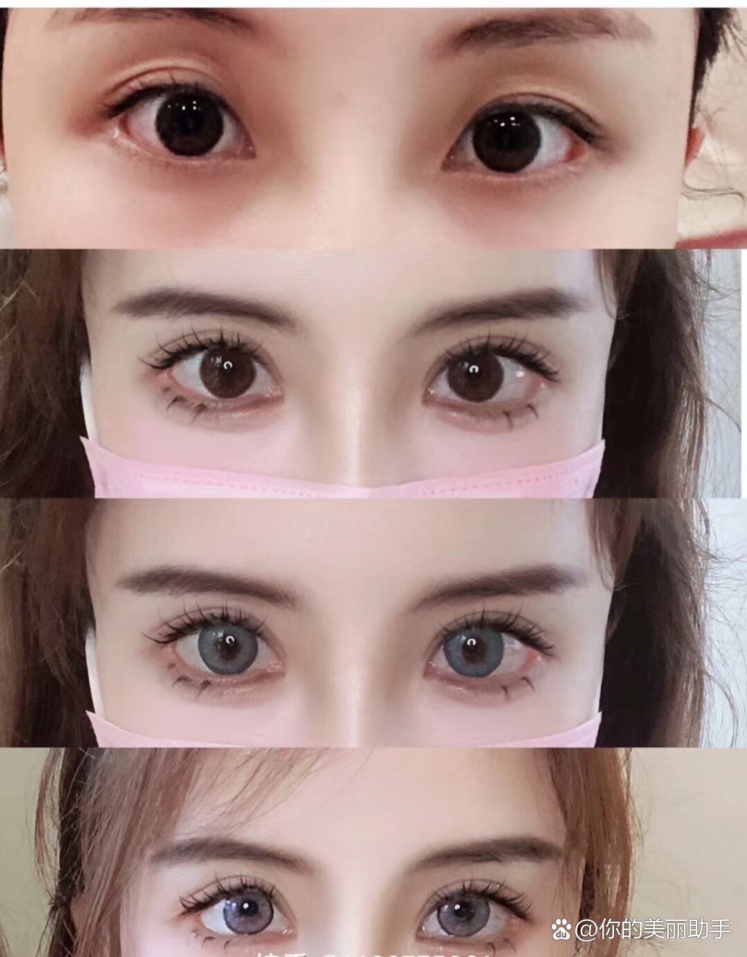 重睑术的三种术式