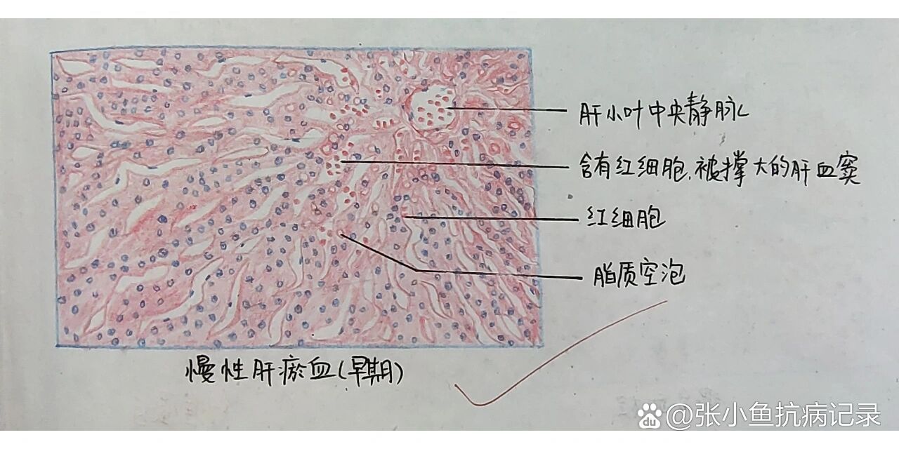 病理学实验绘图—慢性肝,肺淤血,混合血栓