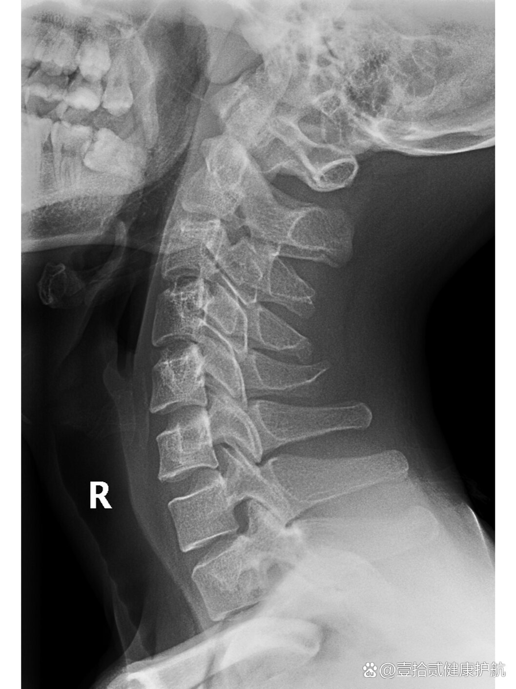 颈椎侧位片正常的图片图片