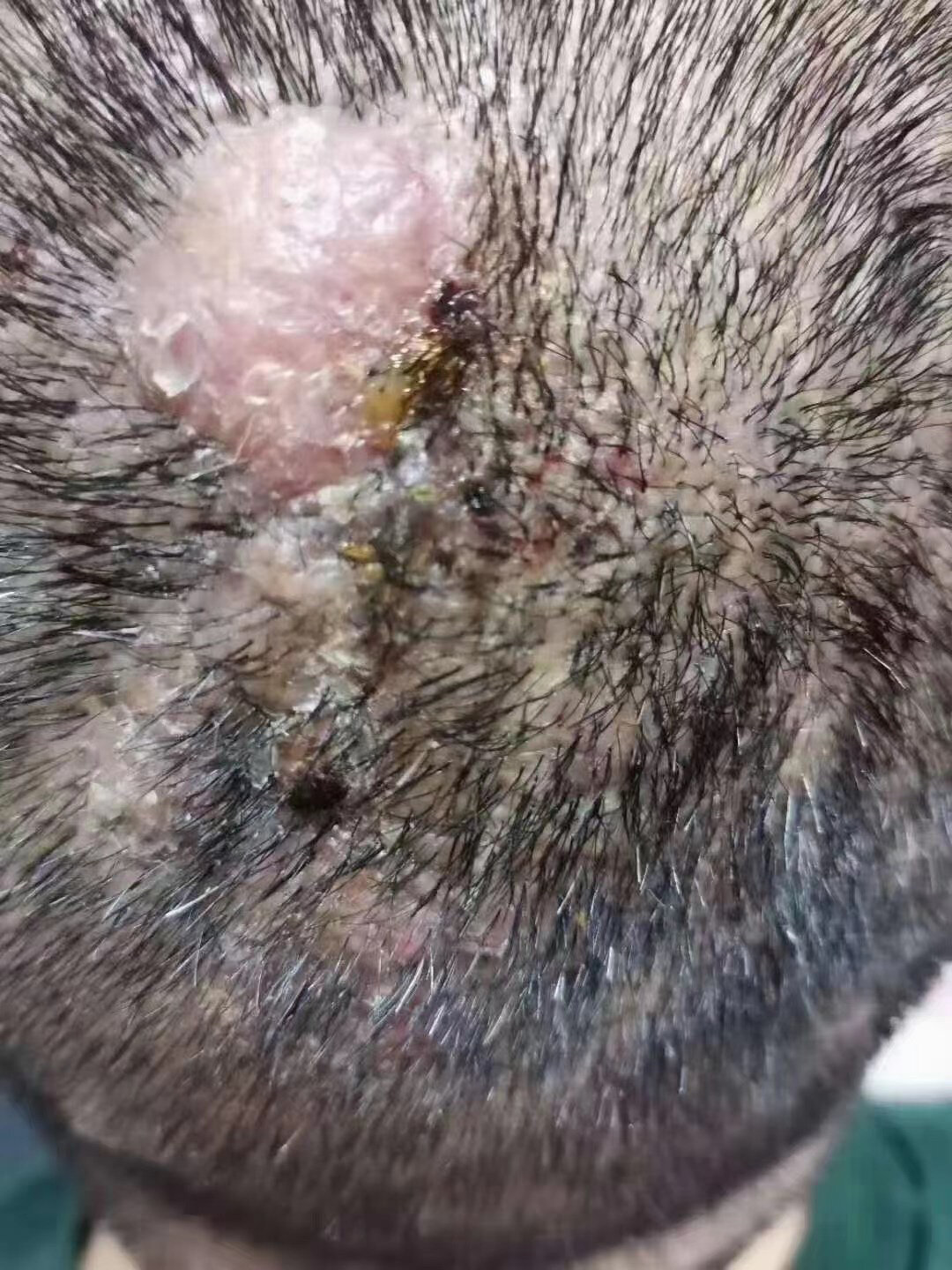 多年头皮毛囊炎终于改善了案例分享