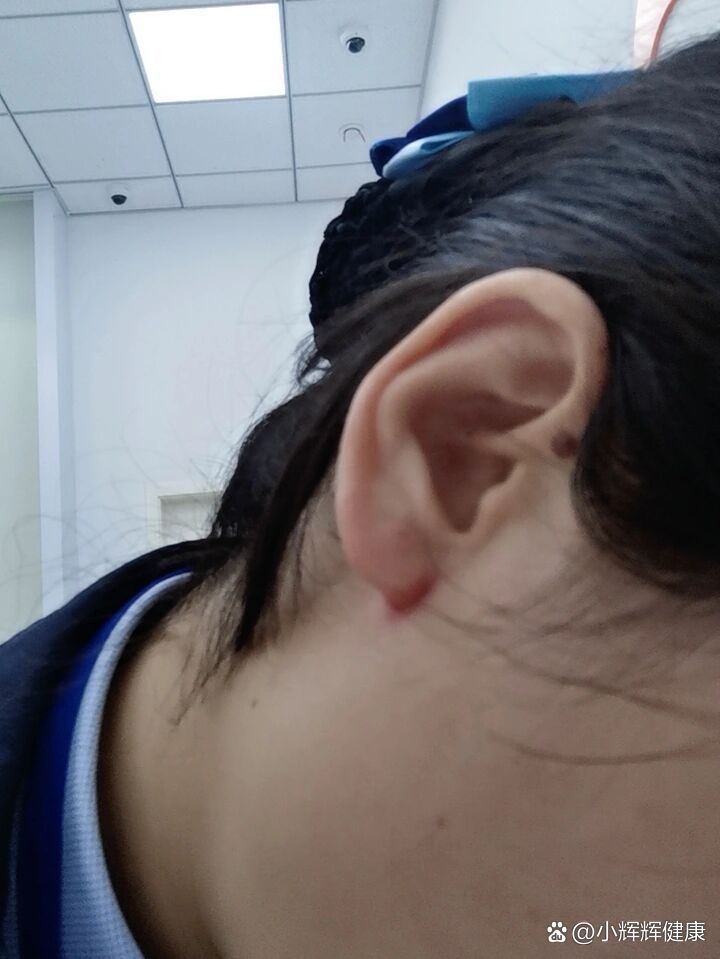 耳朵根裂开