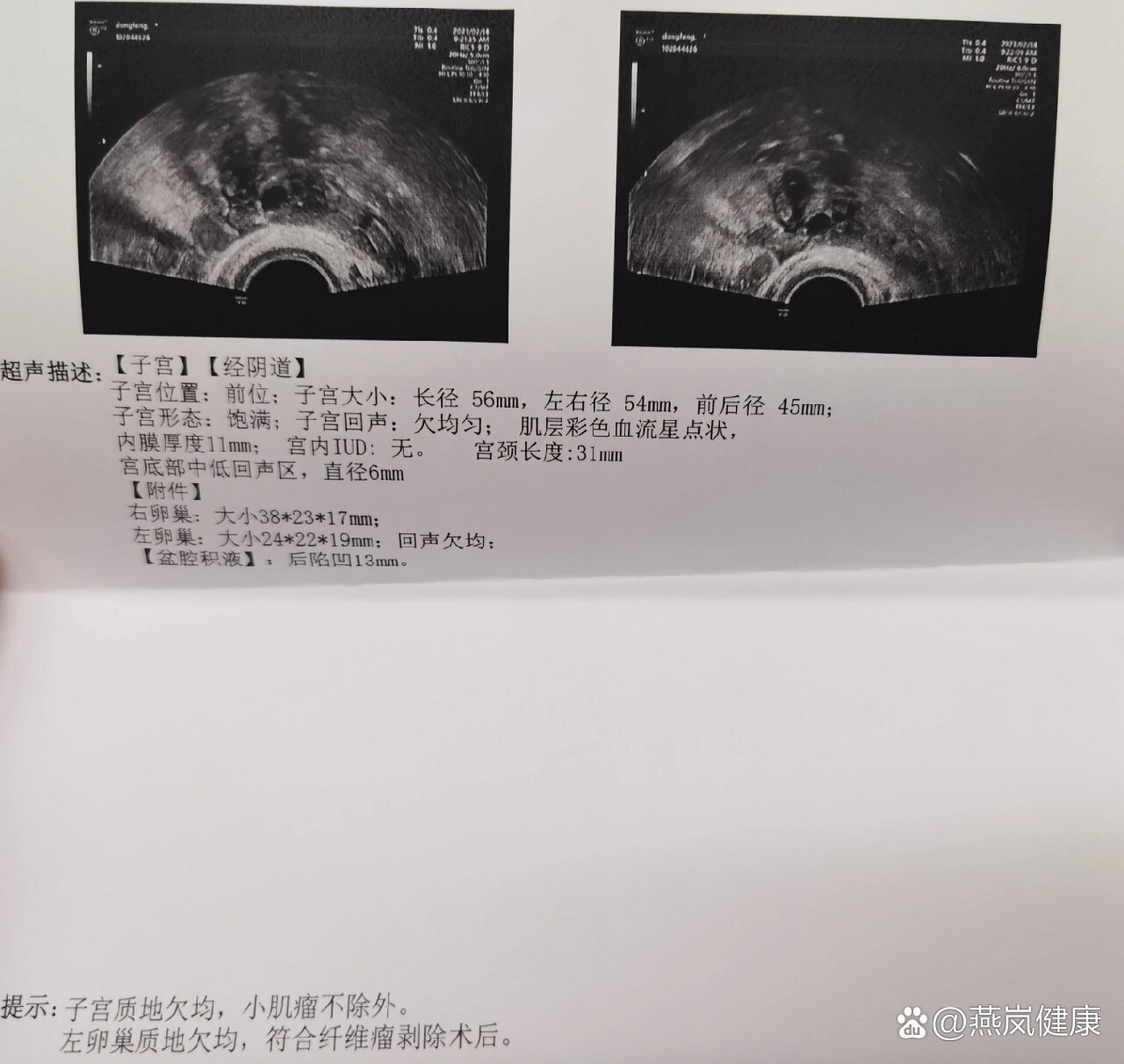 腹腔镜手术后一个月首次复查阴超