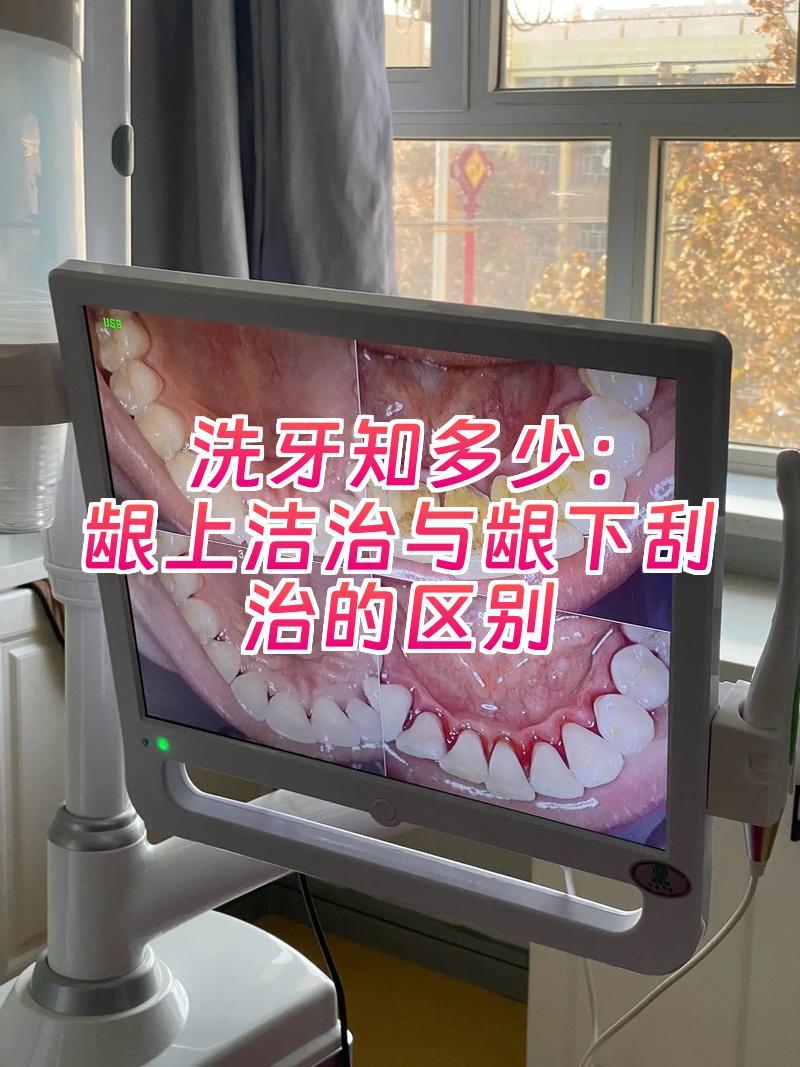 洗牙知多少：龈上洁治与龈下刮治的区别