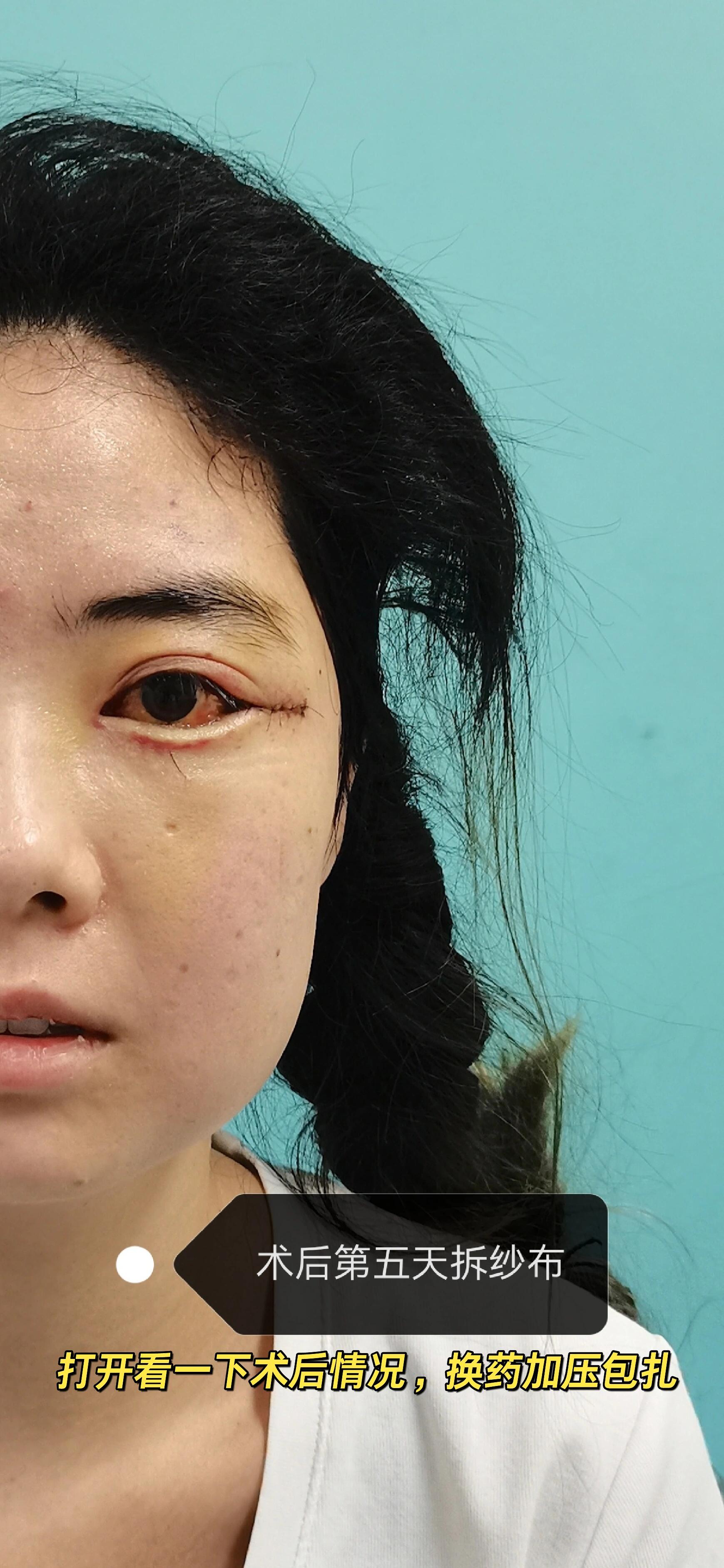 眼眶减压术:你想知道的问题都放这里啦!