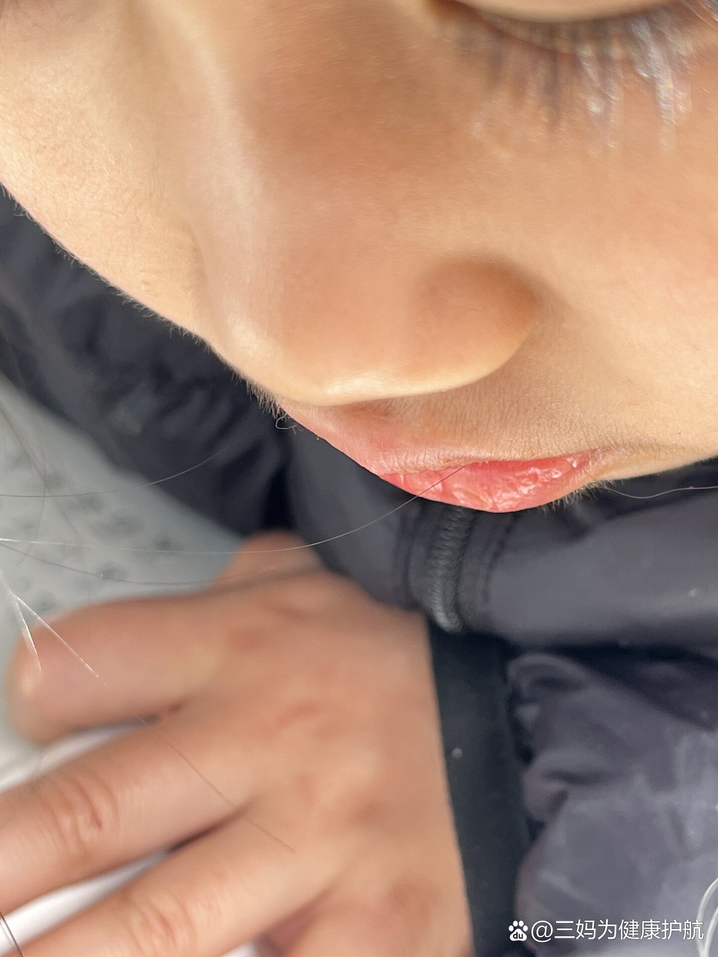 七岁嘴上长了一圈绒毛,怎么回事啊,还是个女孩子,有同样情况的吗?