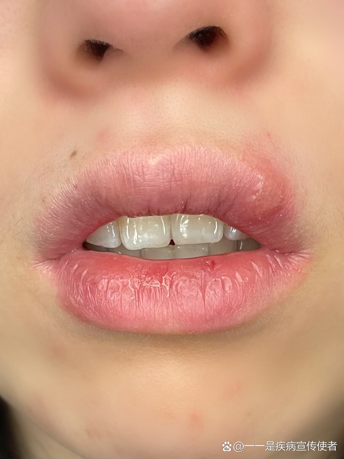 发烧肿成了香肠嘴