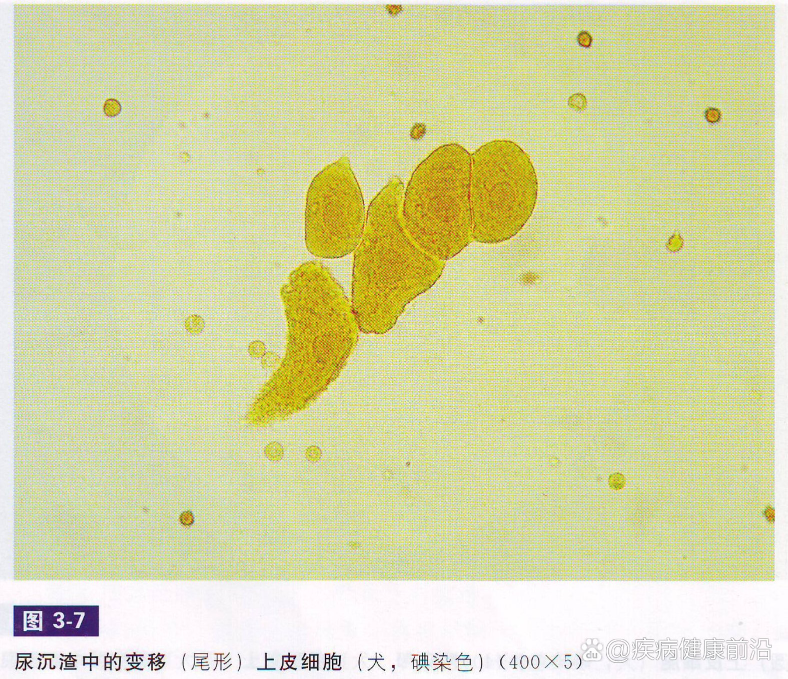 尿沉渣镜检图片