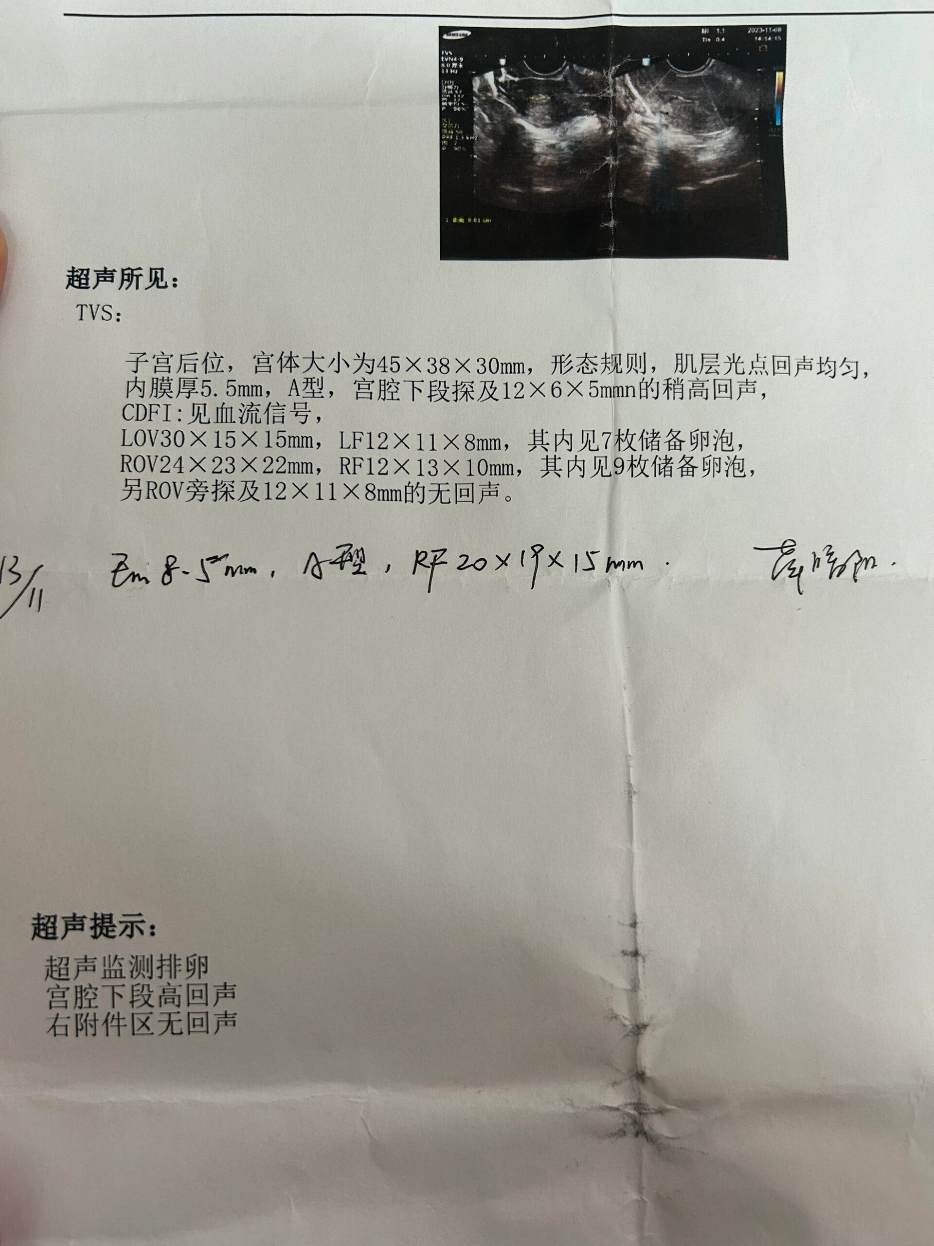 求助:宫腔下端高回声要紧吗?