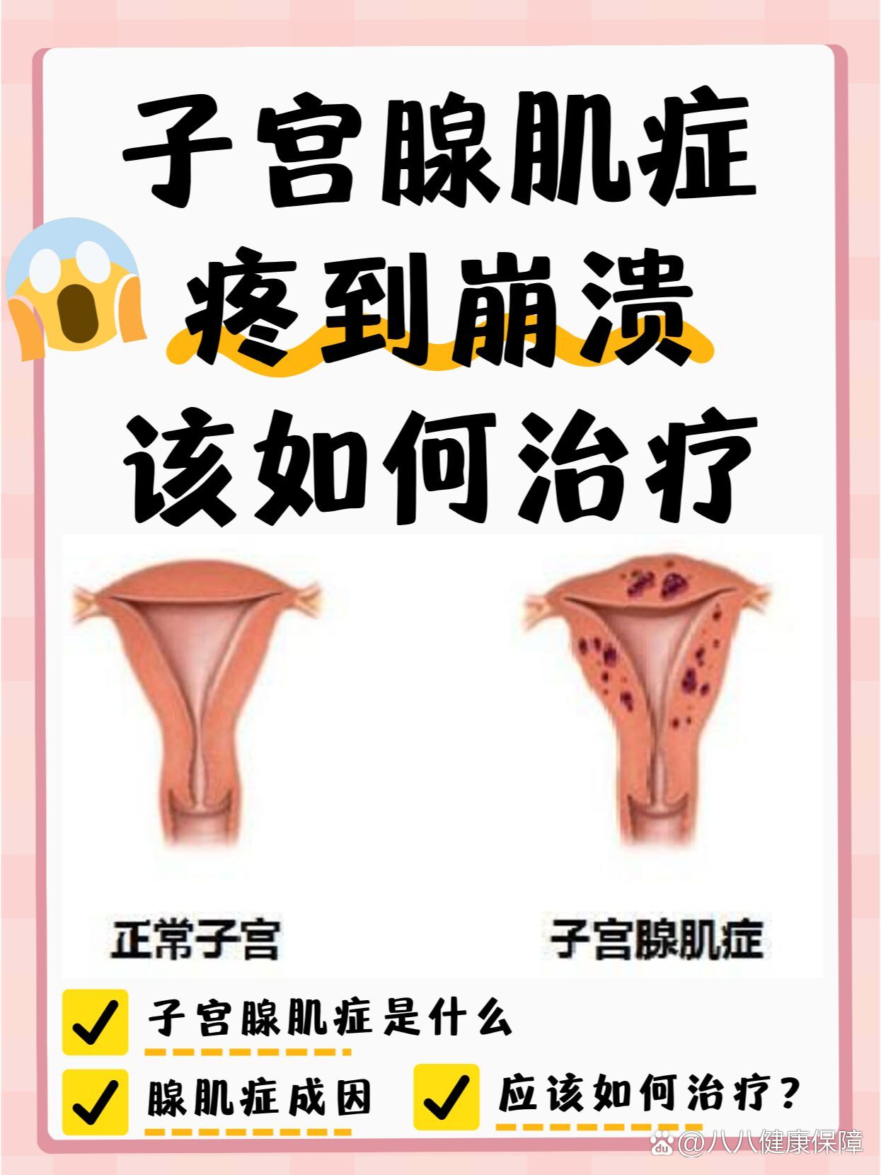 子宫腺肌症是怎么得的图片