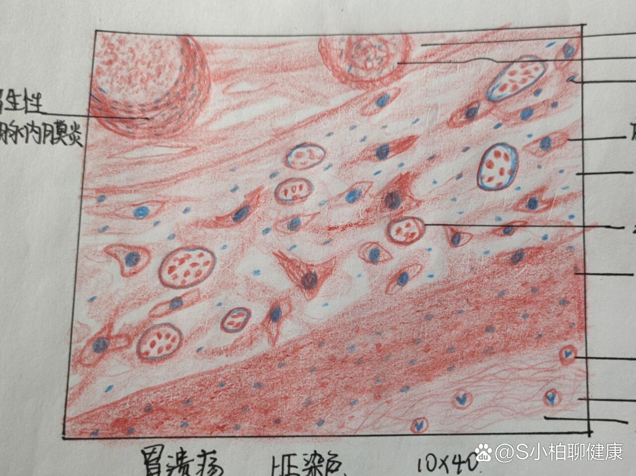 胃溃疡病理手绘图图片