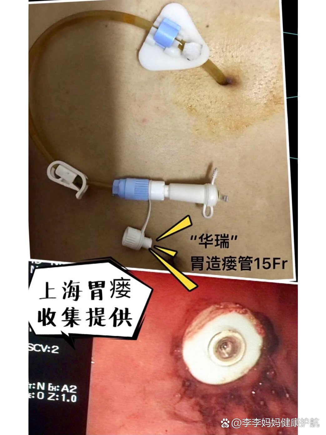 福瑞可胃造瘘(胃造口)管简介