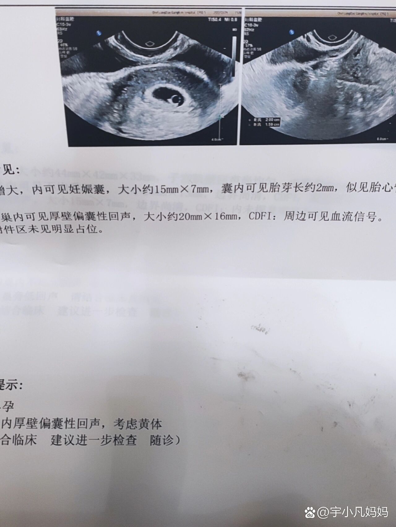 宫外孕后宝宝要超度吗-宫外孕胚胎会自己流出去吗