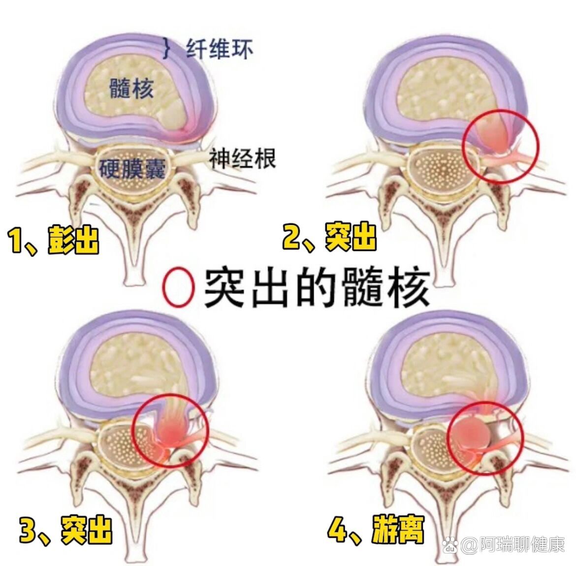 腰椎间盘突出影像图解图片