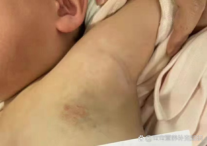 混合型血管瘤(皮肤表面有红斑,皮肤里面有淤青包块)经过微创治疗后