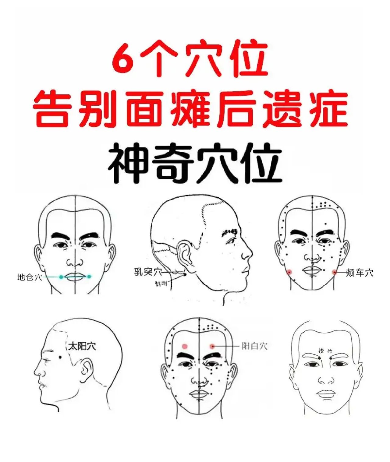 针灸治疗——面瘫