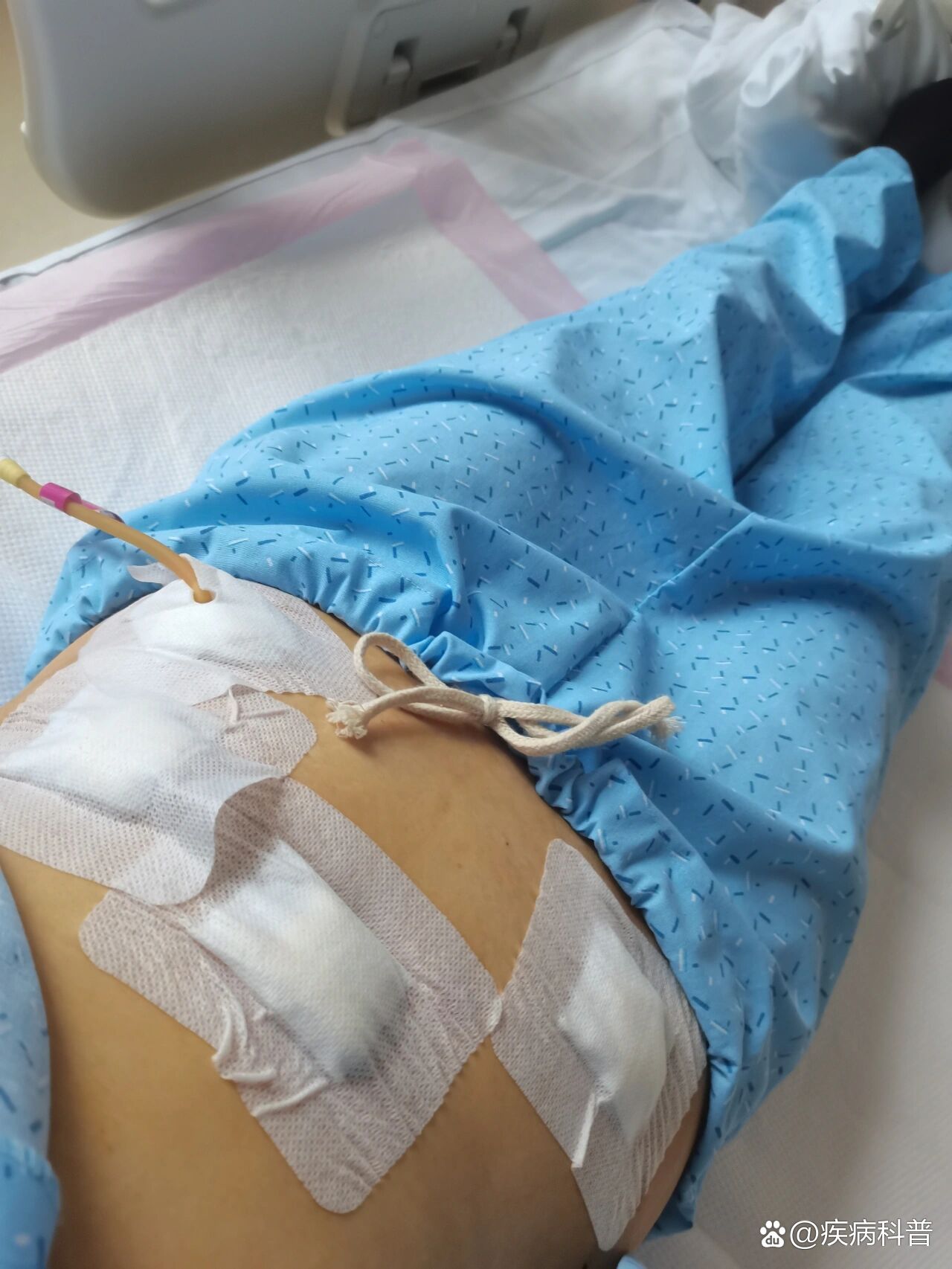 巧克力囊肿腹腔镜手术第二天