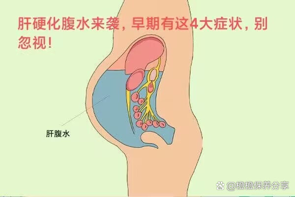 女性肝腹水早期症状图片