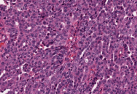 患有膀胱原位癌不恐慌,积极手术保健康