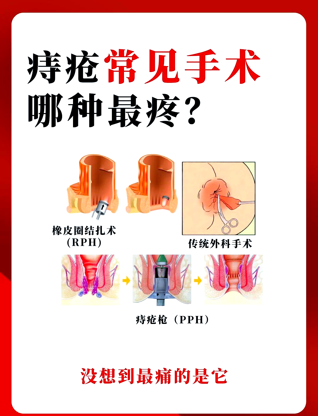 痔疮手术疼痛度大揭秘！