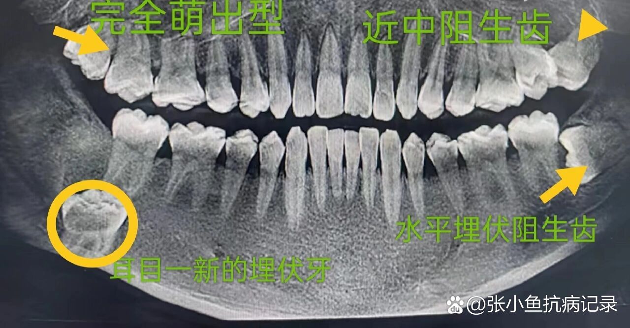 横向埋伏牙图片