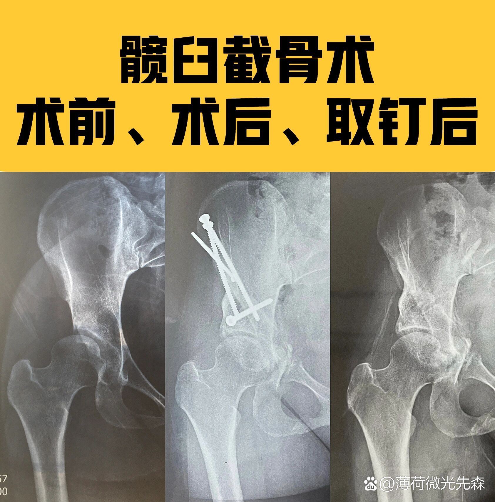 皮质截骨图片图片