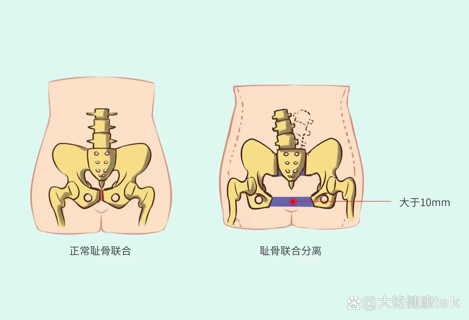 耻骨高怎么回事图片