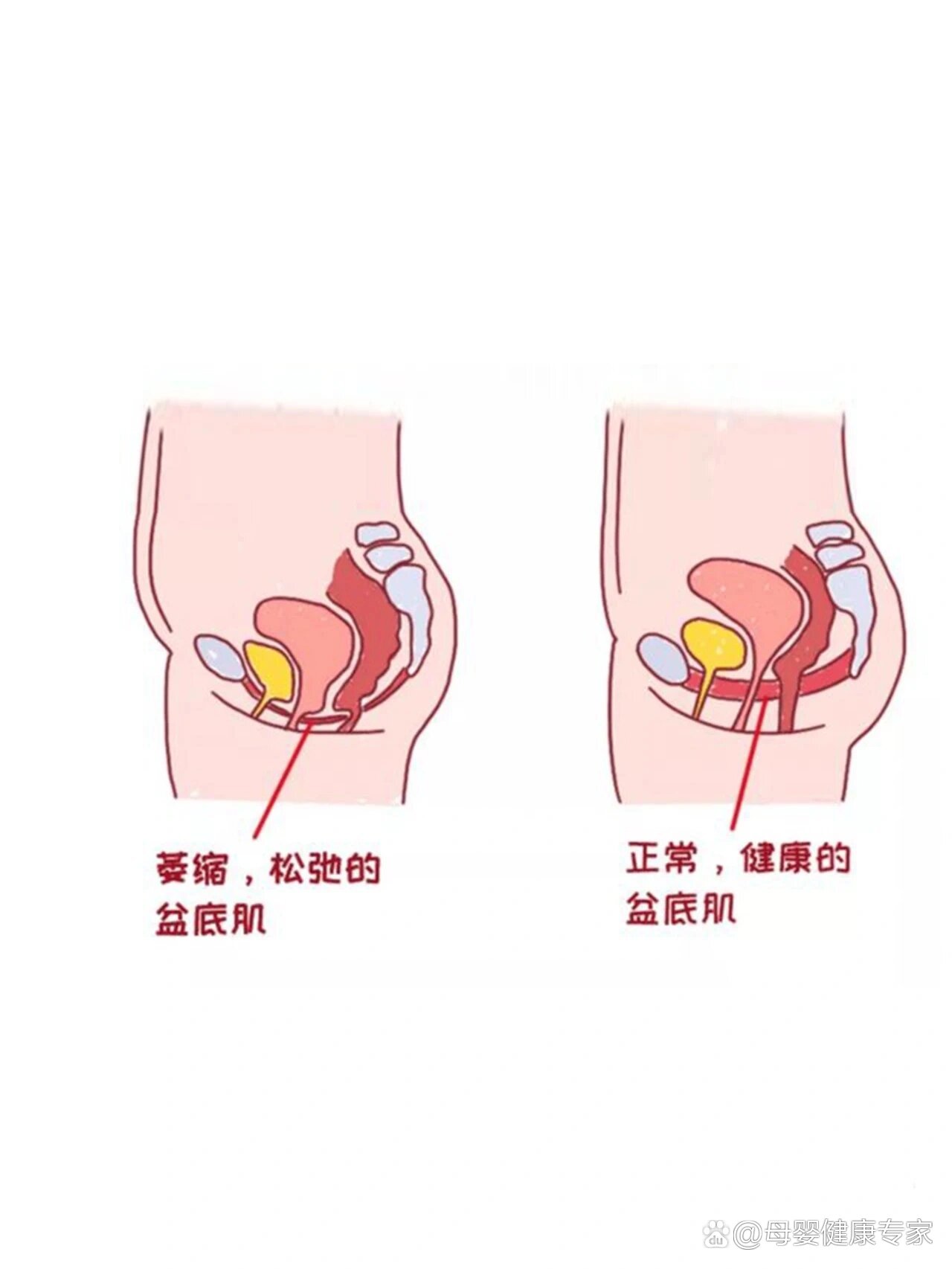 跳绳为什么会漏尿