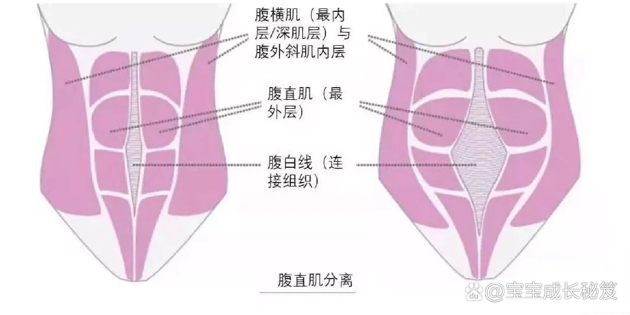 腹直肌分离自测图解图片